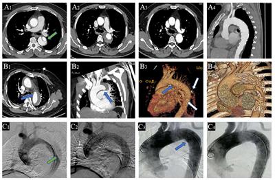 Thoracic Endovascular Aortic Repair for Retrograde Type A Aortic Intramural Hematoma